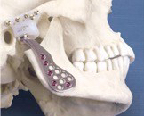 인공턱관절 치환술 – I : 재료 및 기계적&nbsp;특성