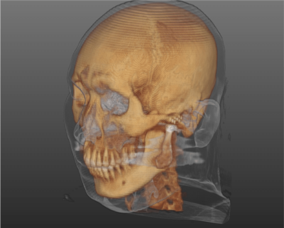 악안면영역의 임플란트로서의 인공턱관절재건술: Part II –&nbsp;외과적술식